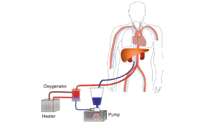 NORMOTHERMIC REGIONAL PERFUSION (NRP PERFUSION)